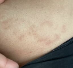 Does anyone know what this rash/marks are?