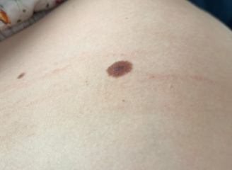 Weird red marks on belly?