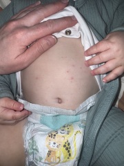 Is this chicken pox? (Pic attached)