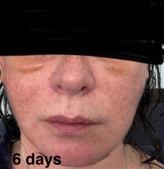 Having facelift surgery in 10 days - support and advice needed