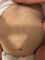 Is this chicken pox? (Pic attached)