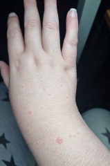 Rash on back of hands- Adult