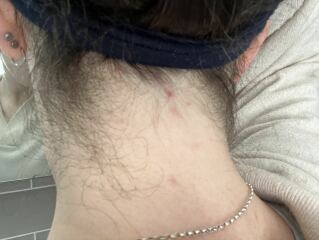 Has anyone had the hairline on their neck lasered?