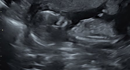 Please help! Girl Or Boy, Nub theory!