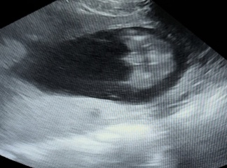 Boy or girl? 17w