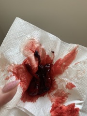 *GRAPHIC* Is this a miscarriage?