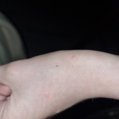 Chicken pox?