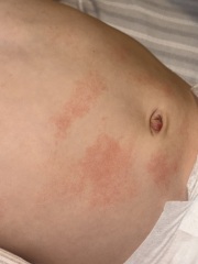 Toddler rash appeared, red belly button. Is it milk allergy again?