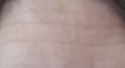 Microneedling, polynucleotides, radio frequency skin tightening?