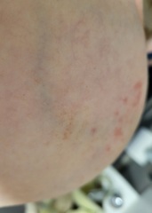 Rash on breast