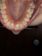Any dentists about? I’m not registered anywhere. It hurts. Should I go private when I’m broke (pictures)