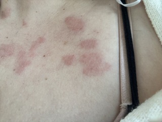Hives , shingles or something else