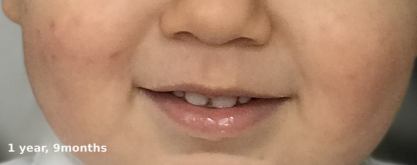 Infantile Acne / Baby Acne at 5 months