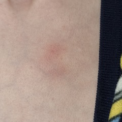 Chicken pox?