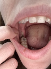 Is this dry socket?