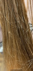 nits or dandruff - please help! (pics)