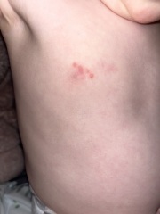 Please anyone any advice on  a rash on my babies back
