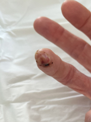 Cut finger - will the tip survive? **TW** Photos