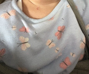 What could this mark be on my one year old?