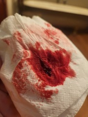 GRAPHIC PICS - Is this a miscarriage