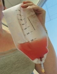 Psst, wanna see what a neurosurgeon drained out of my brain?