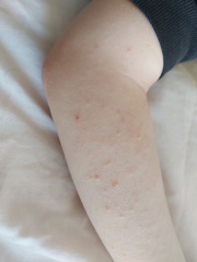 Is this scabies or something else?
