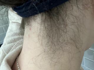 Has anyone had the hairline on their neck lasered?