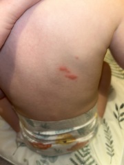 Please anyone any advice on  a rash on my babies back