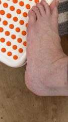 Possible broken bones