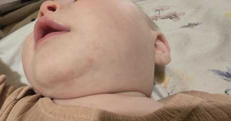 Worried about a rash?