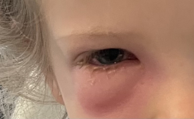 In hospital with DD age4 - peri orbital cellulitis, antibiotics not working?