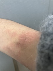 Psoriasis or eczema