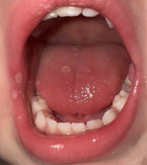White sores toddlers tongue?