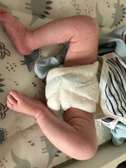 Does this sound like CMPA?