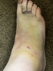 Hurt my ankle on holiday wwyd