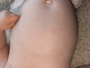 Rash day after 12 week vaccinations?