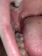Is this dry socket?