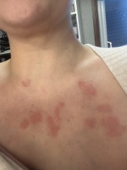 Hives , shingles or something else