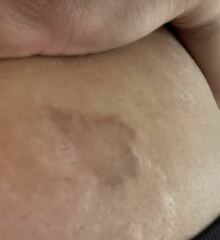 Does anyone know what this rash/marks are?