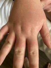 Any rash-identifying gurus around? Pics included.