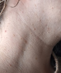 Bumps on face and neck