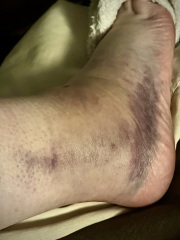 Hurt my ankle on holiday wwyd