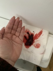 Update: is this a miscarriage?