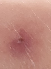 Does this look like a tick bite?