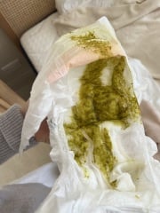 Diarrhea or normal - 5 month old baby