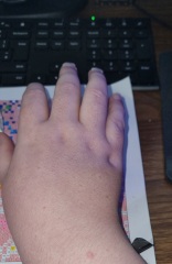 Rash on back of hands- Adult