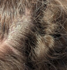 Eczema or psoriasis? (pictures)