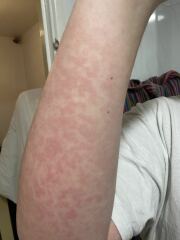 Any rash-identifying gurus around? Pics included.