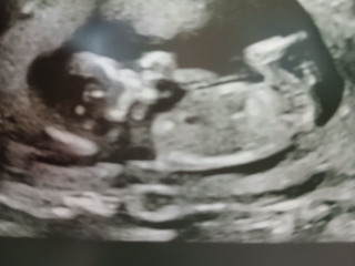 Nub/skull theory at 14 weeks