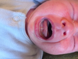 Tongue tie